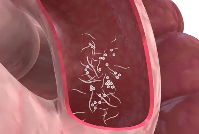 Los síntomas de la presencia de parásitos en el intestino