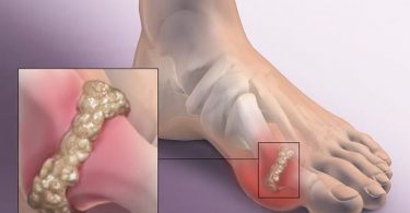 Síntomas de gota y manifestación de cristales de ácido úrico en los pies