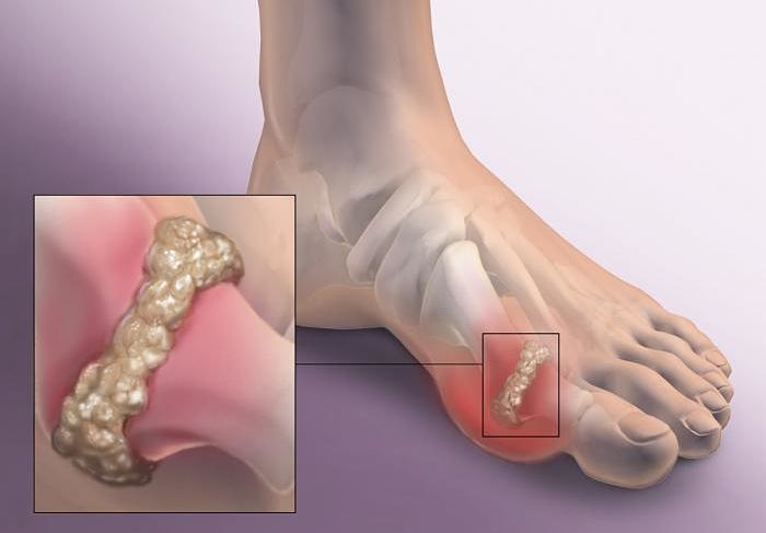 Síntomas de gota y manifestación de cristales de ácido úrico en los pies