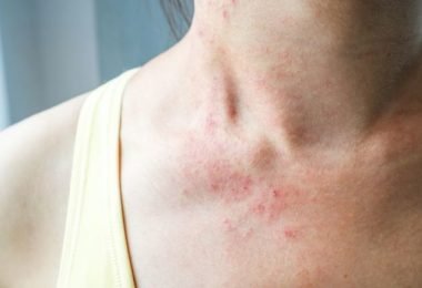 Síntomas de alergia al Alfa Gal