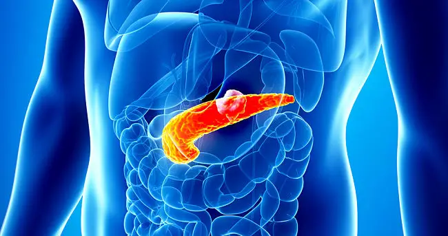 síntomas del cáncer de páncreas