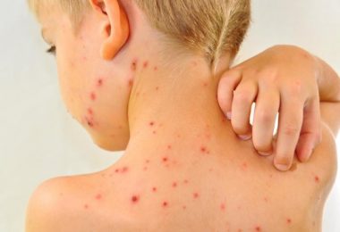 Los síntomas de la fiebre escarlatina en el cuerpo de un