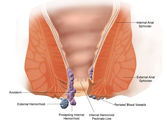 Gráfico que muestra las hemorroides externas