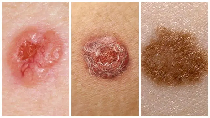 Apariencia del cáncer de piel