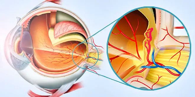 cómo se ve la degeneración macular