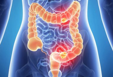 cómo se puede diagnosticar el cáncer de colon y cómo tratarlo