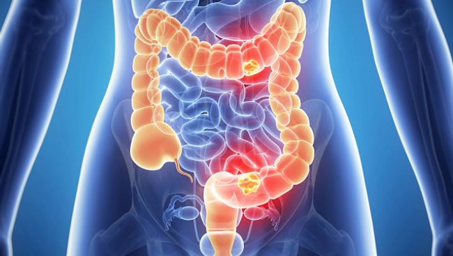 cómo se puede diagnosticar el cáncer de colon y cómo tratarlo