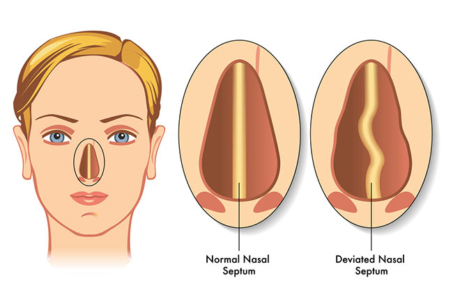 gráfico del tabique desviado