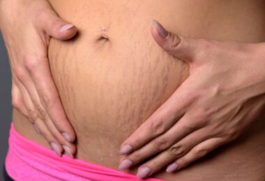 Estrías en mujeres embarazadas y como tratarla naturalmente