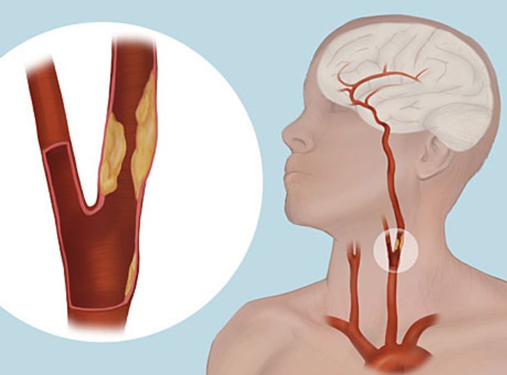 Conoce los factores que causan problemas de arterias obstruidas