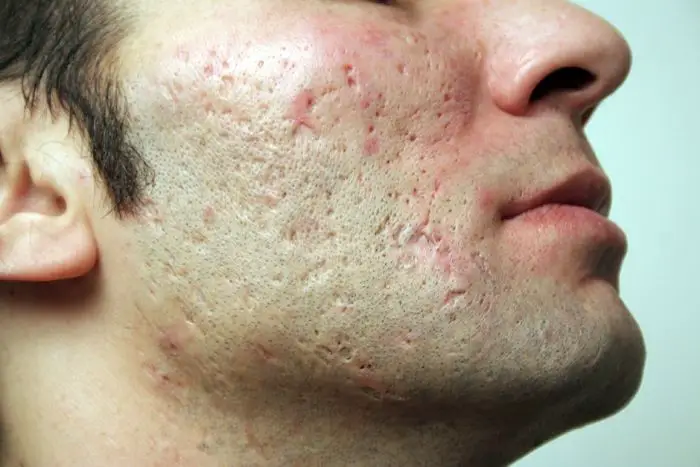 Hombre con cicatrices del acné