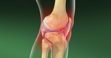 Ejercicio para tratar artrosis de rodilla