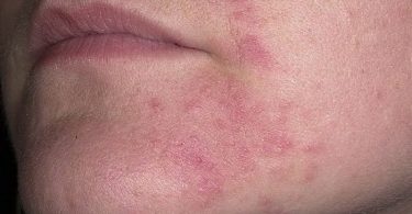 Reacción alérgica en el rostro por alergia al sol