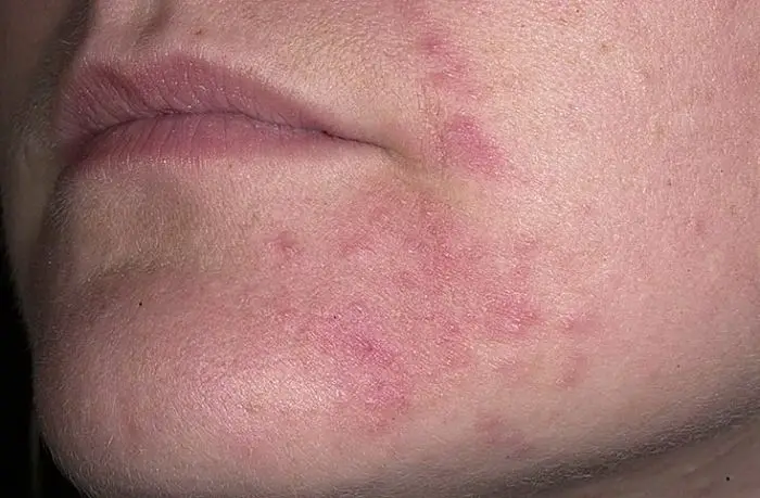 Reacción alérgica en el rostro por alergia al sol