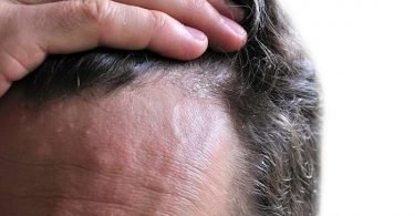 Síntomas de dermatitis seborreica en la frente