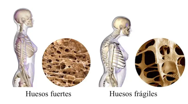 tratamiento para la osteoporosis