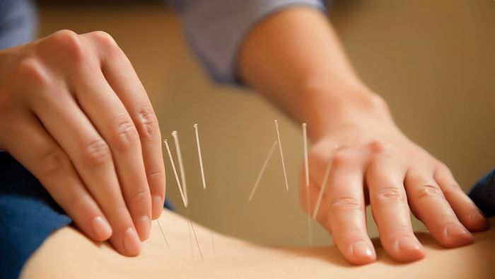 mujer haciendo acupuntura