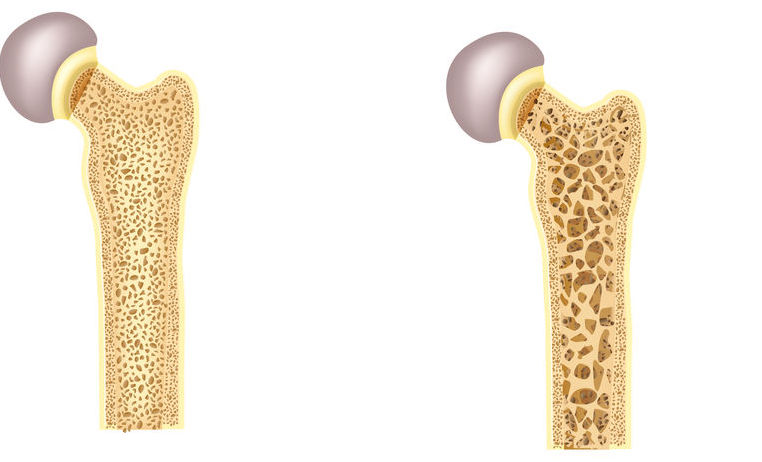 osteopenia