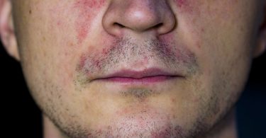 Causas de la dermatitis perioral