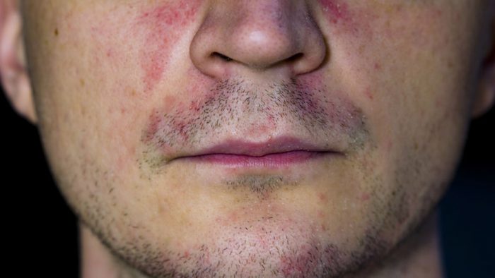 Causas de la dermatitis perioral 