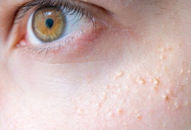 Milium sebáceo en piel de ojos
