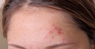 Una mujer que tiene piel mixta y formación de acné