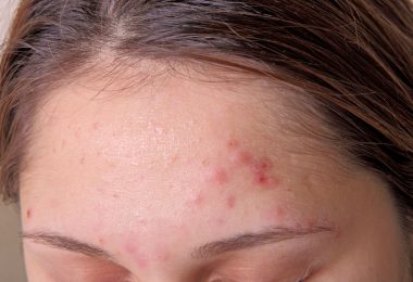 Una mujer que tiene piel mixta y formación de acné
