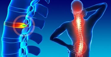 causas y síntomas de las hernias de sico