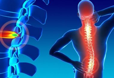 causas y síntomas de las hernias de sico