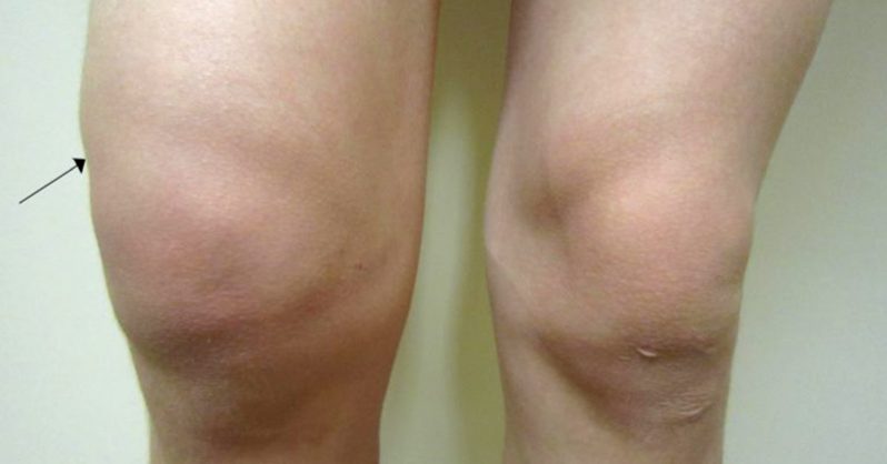 edema en la fibromialgia