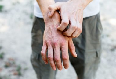 Persona que padece eccema dishidrótico