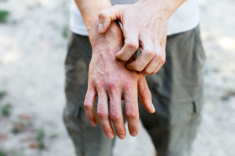 Persona que padece eccema dishidrótico