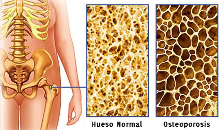 pérdida ósea