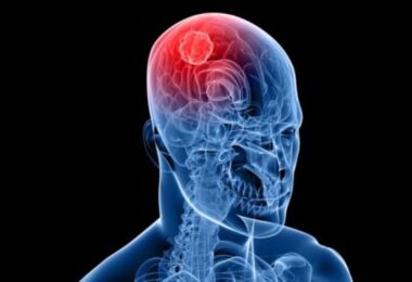 Señales de advertencia de un accidente cerebrovascular
