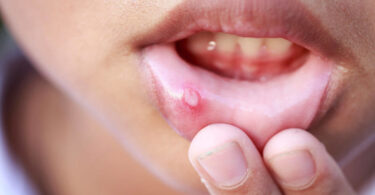 Ulcera en la boca