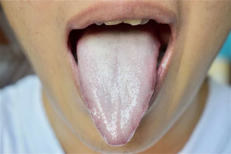 Persona con la lengua pálida por deficiencia de vitamina B12