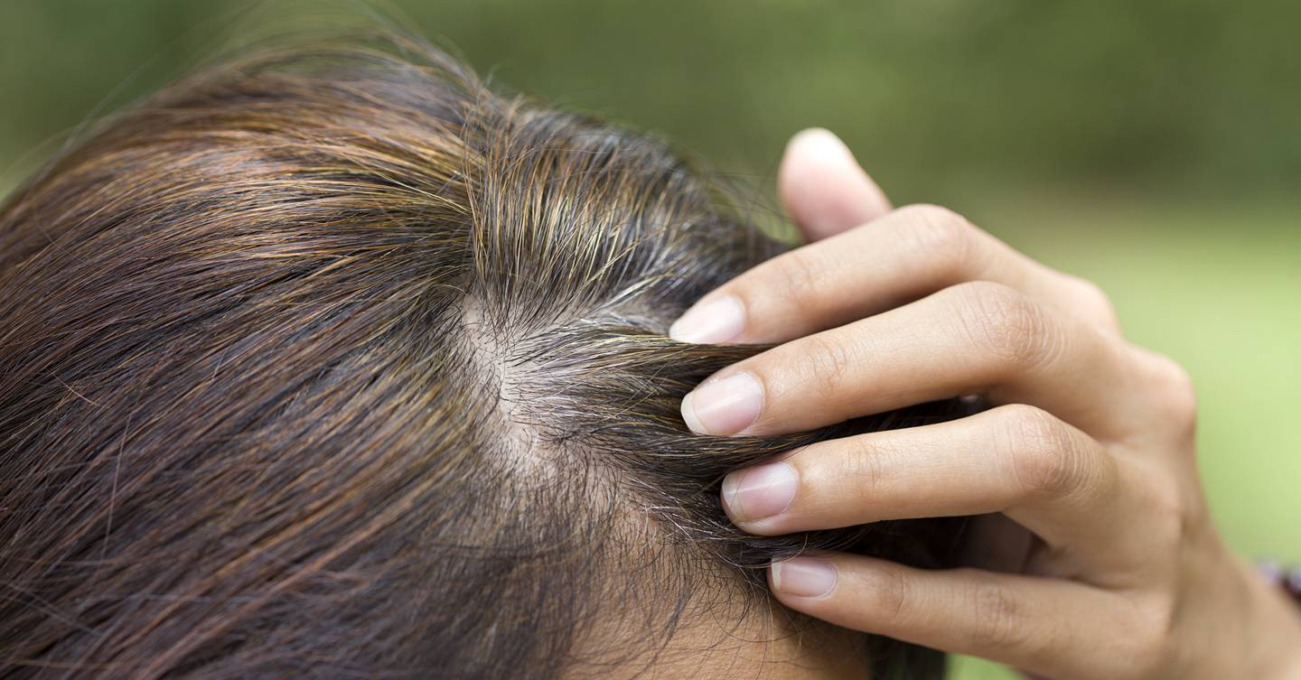 Mujer que padece caída del cabello por menopausia