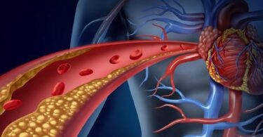 Niveles de colesterol altos mayor riesgo de enfermedad coronaria