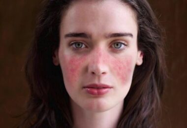 Las manchas con forma de mariposa en el rostro que son señales del lupus