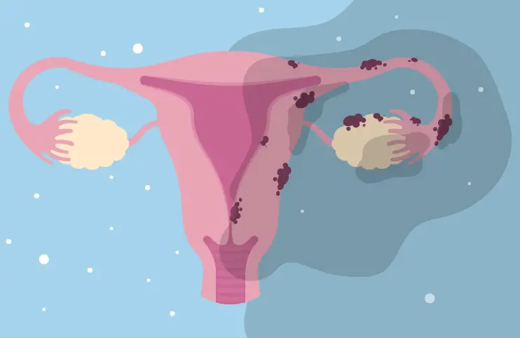endometriosis mostrado en un útero y ovarios