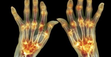 síntomas de la artritis juvenil y cómo se trata