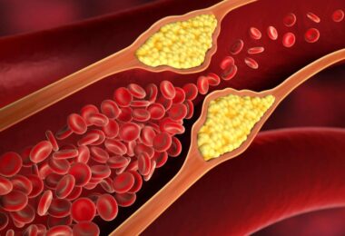 Arterías obstruidas y alimentos peligrosos