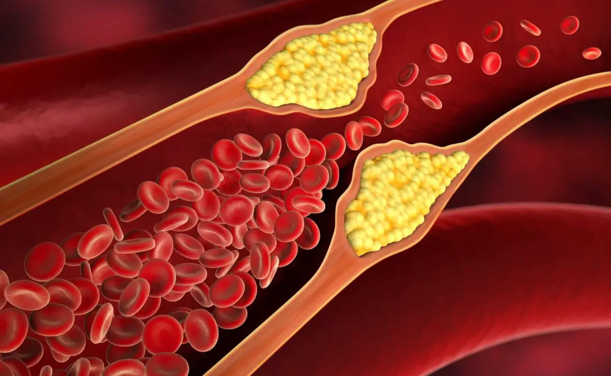 Arterías obstruidas y alimentos peligrosos