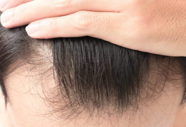 Pérdida de cabello por COVID-19
