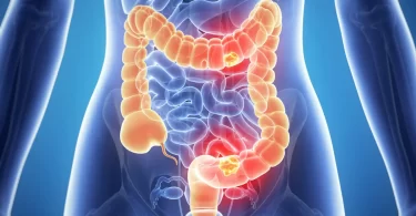 Señales de que sufres colitis ulcerosa