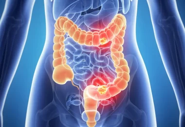 Señales de que sufres colitis ulcerosa