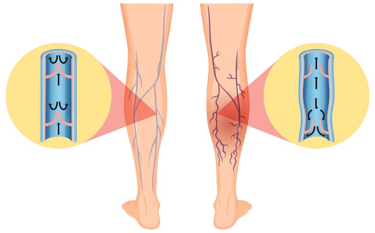 venas varicosas