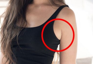 Mujer con grasa en las axilas