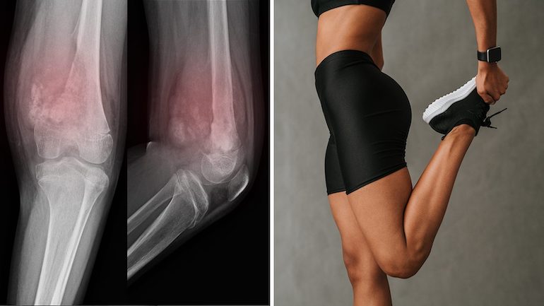 imagen mujer ropa deportiva haciendo estiramientos radiografía de  rodillas
