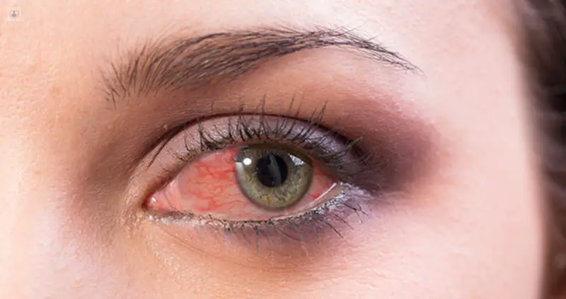 Deficiencia de omega-3 que aparece en los ojos